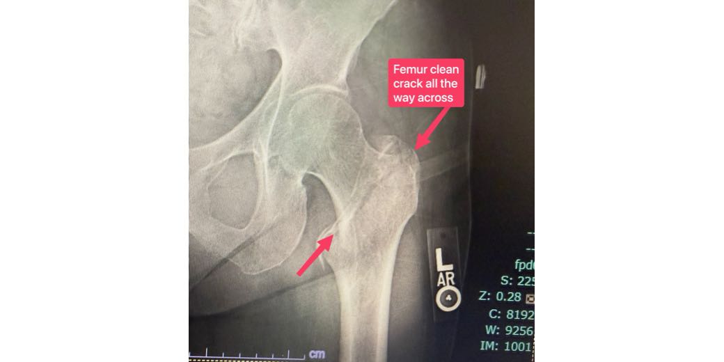 X-ray of a femur bone with a diagonal break across near the top. It's annotated to help people see the crack
