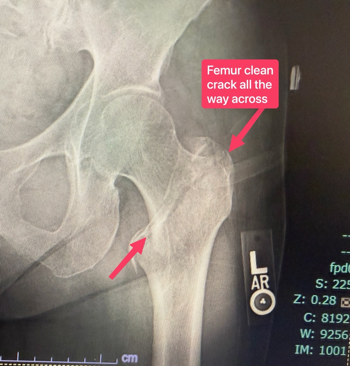 Allison Hip x-ray showing fracture annotated.jpeg Allison Hip x-ray showing fracture annotated as described