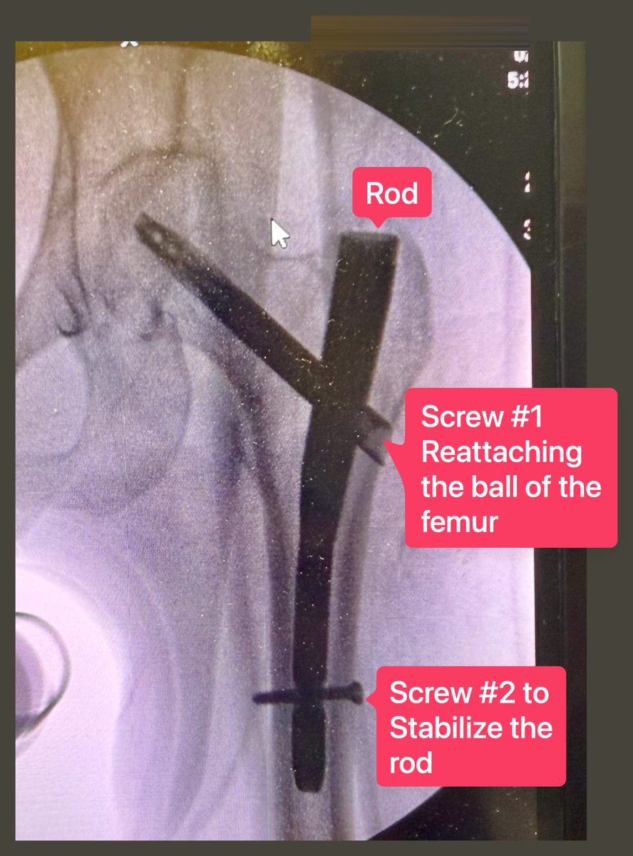 Allison hip x-ray rod and screws annotated.png Allison hip x-ray rod and screws annotated as described