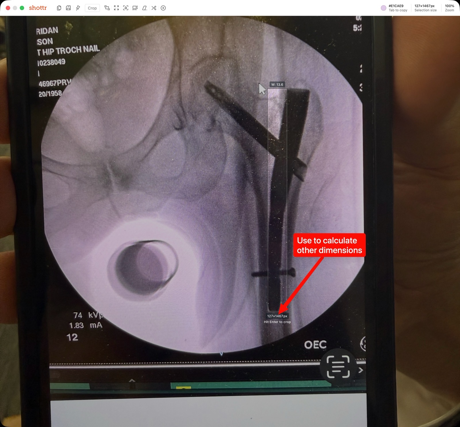 X-ray calculating dimensions using pixels in Shottr.